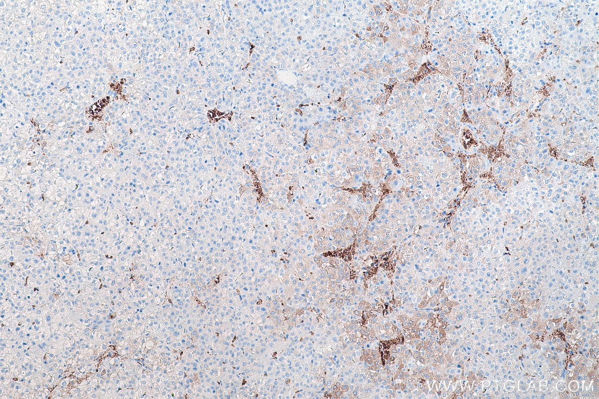 Immunohistochemical analysis of paraffin-embedded human liver cancer tissue slide using KHC0556 (HBB IHC Kit).