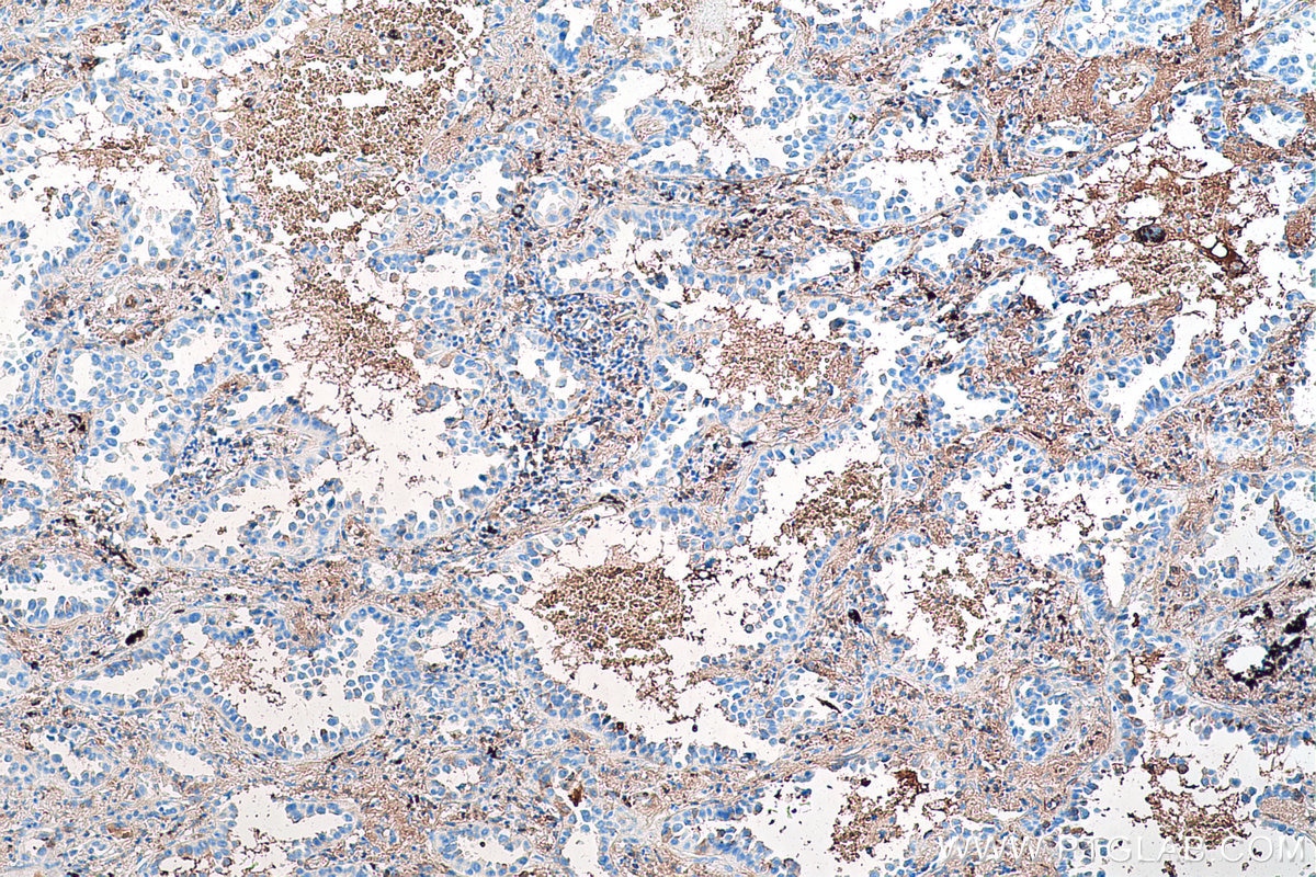 Immunohistochemical analysis of paraffin-embedded human lung cancer tissue slide using KHC0556 (HBB IHC Kit).