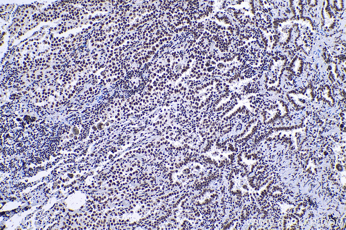 Immunohistochemical analysis of paraffin-embedded human lung cancer tissue slide using KHC0613 (HDAC1 IHC Kit).