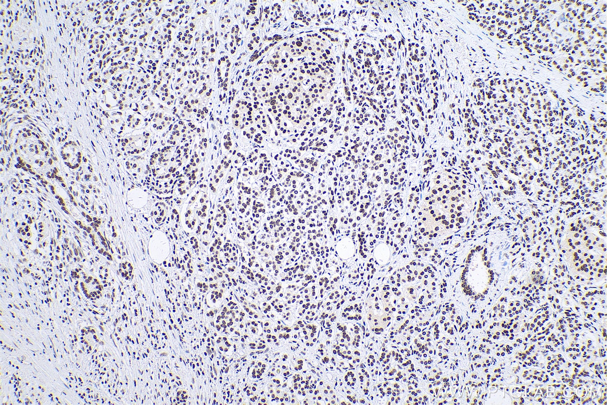 Immunohistochemical analysis of paraffin-embedded human pancreas cancer tissue slide using KHC0613 (HDAC1 IHC Kit).