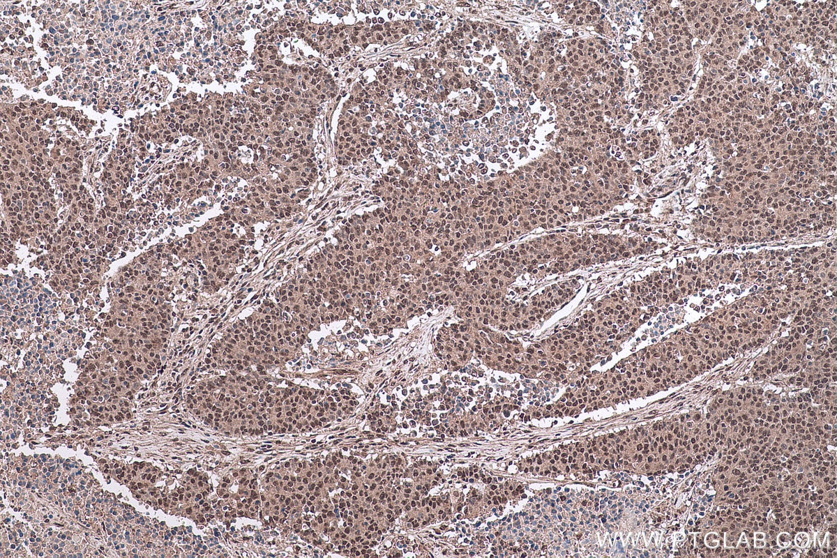 Immunohistochemical analysis of paraffin-embedded human colon cancer tissue slide using KHC0618 (HDAC10 IHC Kit).