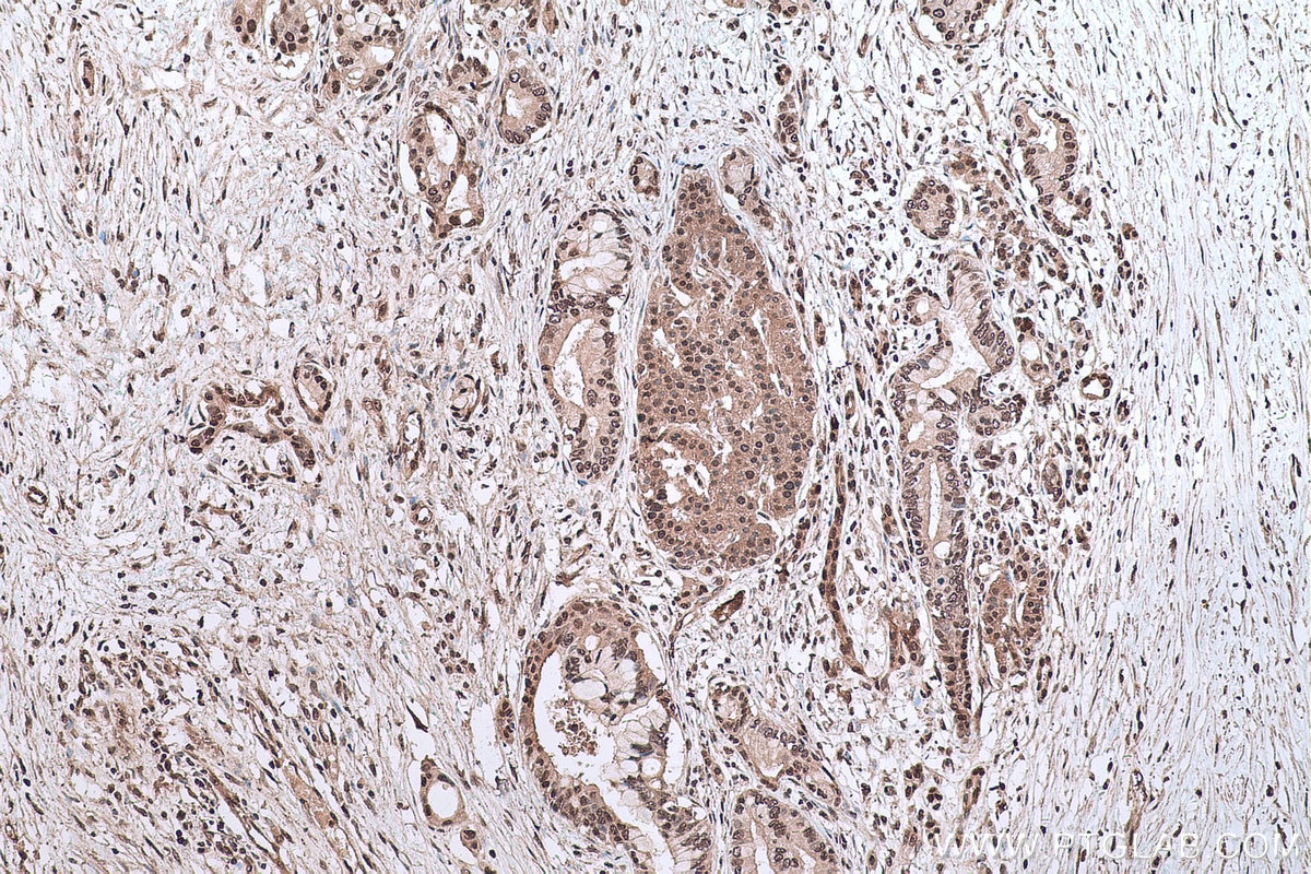 Immunohistochemical analysis of paraffin-embedded human pancreas cancer tissue slide using KHC0618 (HDAC10 IHC Kit).