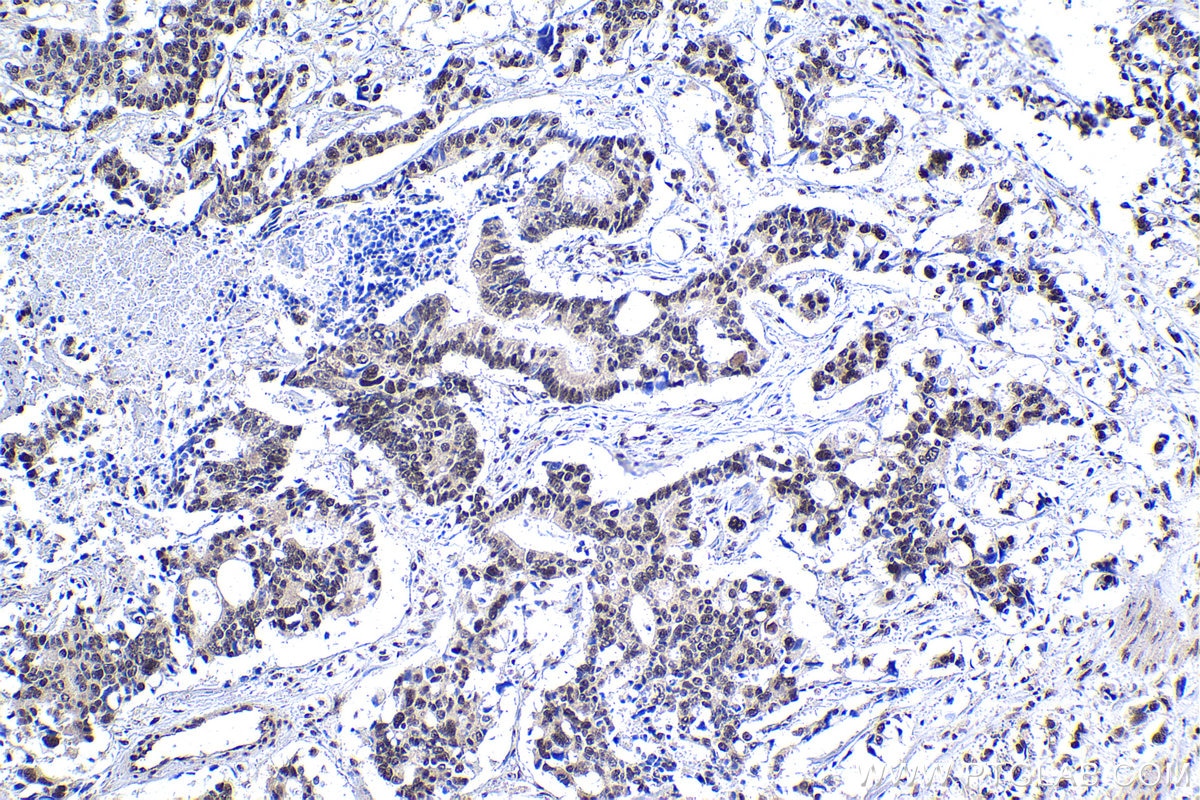 Immunohistochemical analysis of paraffin-embedded human stomach cancer tissue slide using KHC1853 (HDAC2 IHC Kit).
