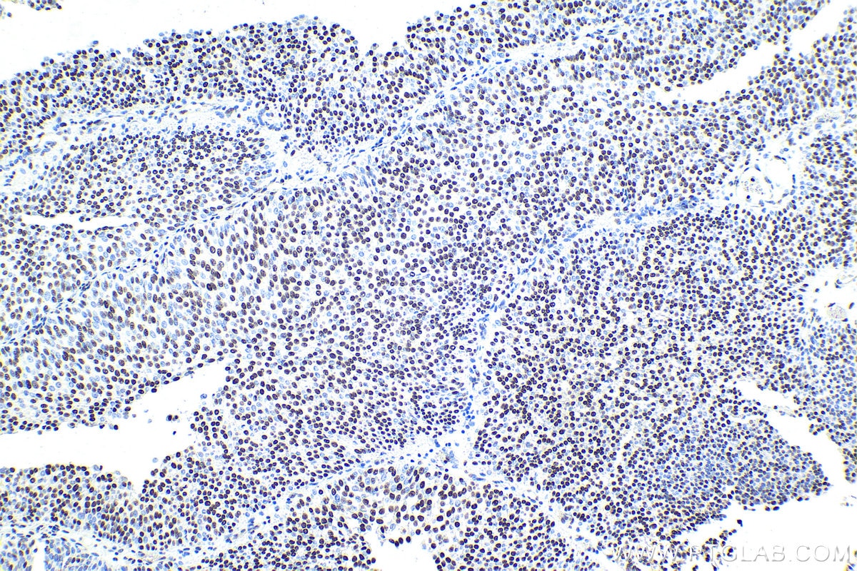 Immunohistochemical analysis of paraffin-embedded human urothelial carcinoma tissue slide using KHC1853 (HDAC2 IHC Kit).