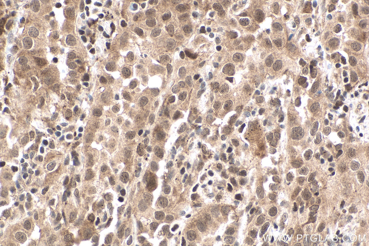 Immunohistochemical analysis of paraffin-embedded human lung cancer tissue slide using KHC0614 (HDAC3 IHC Kit).