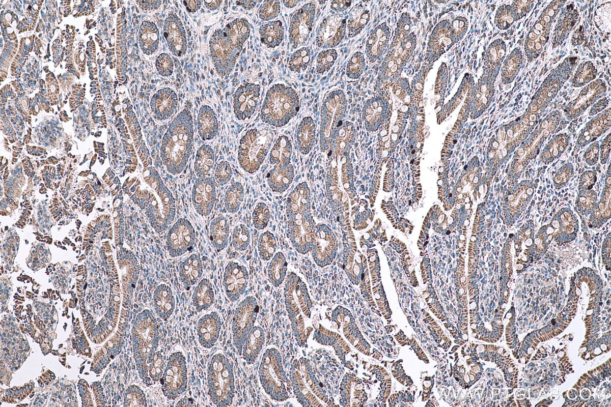 Immunohistochemical analysis of paraffin-embedded human stomach cancer tissue slide using KHC0615 (HDAC5 IHC Kit).