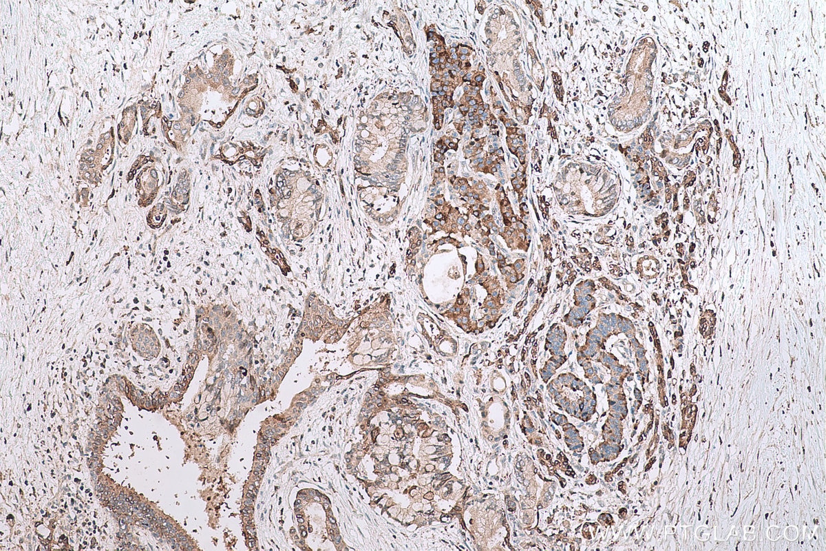 Immunohistochemical analysis of paraffin-embedded human pancreas cancer tissue slide using KHC0615 (HDAC5 IHC Kit).