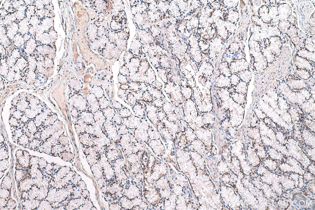 Immunohistochemical analysis of paraffin-embedded human stomach cancer tissue slide using KHC0616 (HDAC6 IHC Kit).