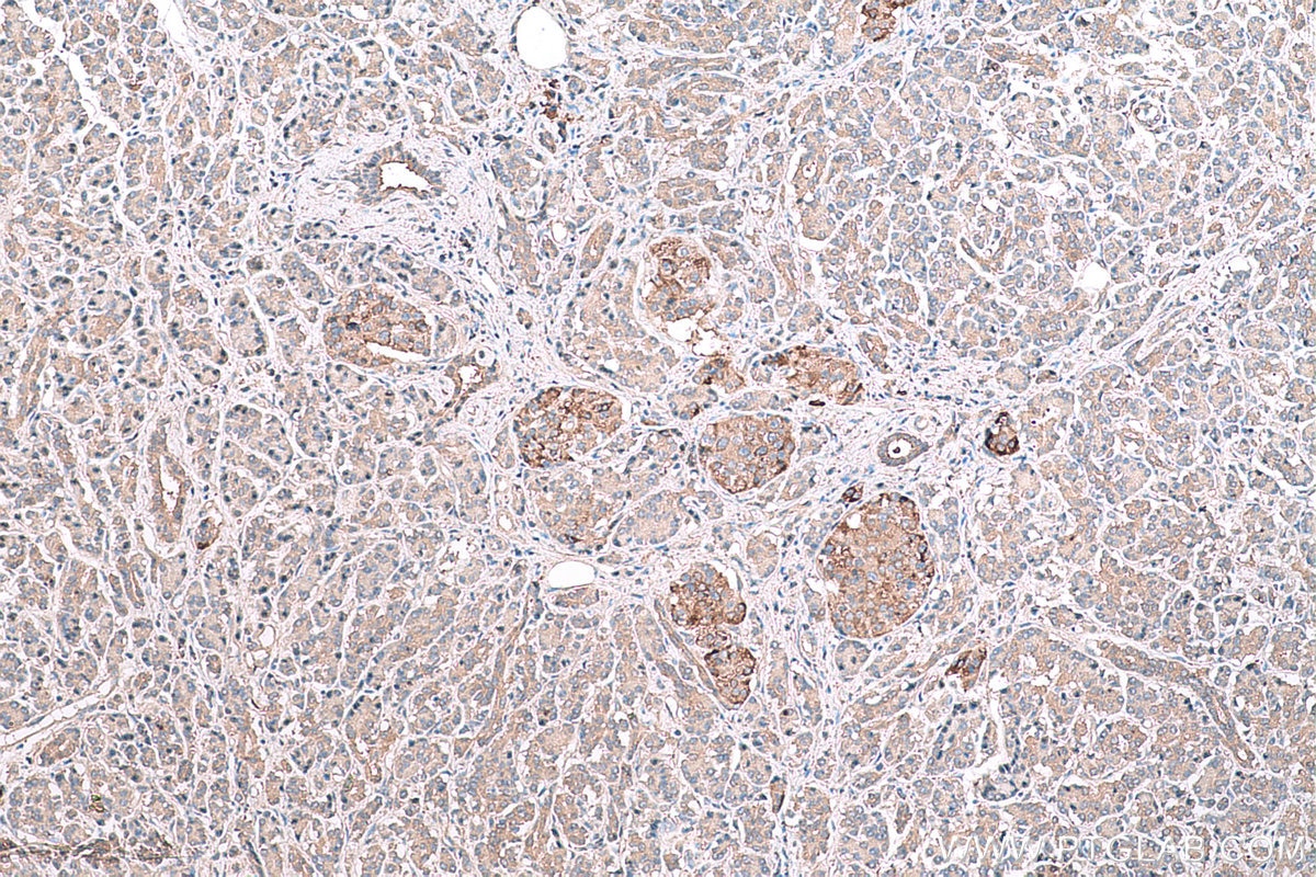 Immunohistochemical analysis of paraffin-embedded human pancreas cancer tissue slide using KHC0616 (HDAC6 IHC Kit).