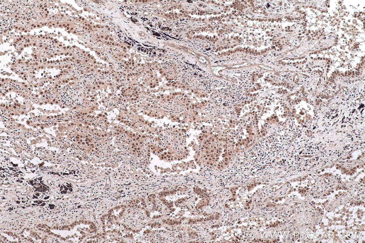 Immunohistochemical analysis of paraffin-embedded human lung cancer tissue slide using KHC0617 (HDAC8 IHC Kit).