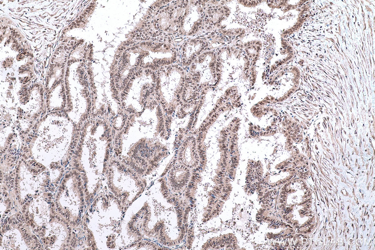 Immunohistochemical analysis of paraffin-embedded human ovary tumor tissue slide using KHC0617 (HDAC8 IHC Kit).