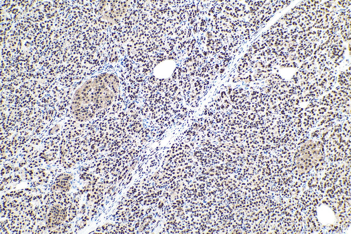 Immunohistochemical analysis of paraffin-embedded human pancreas cancer tissue slide using KHC0898 (HDGF IHC Kit).