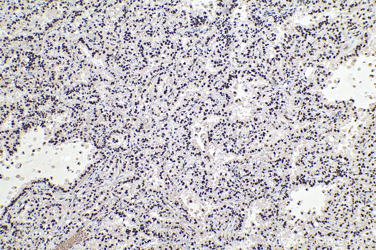 Immunohistochemical analysis of paraffin-embedded human lung cancer tissue slide using KHC0898 (HDGF IHC Kit).