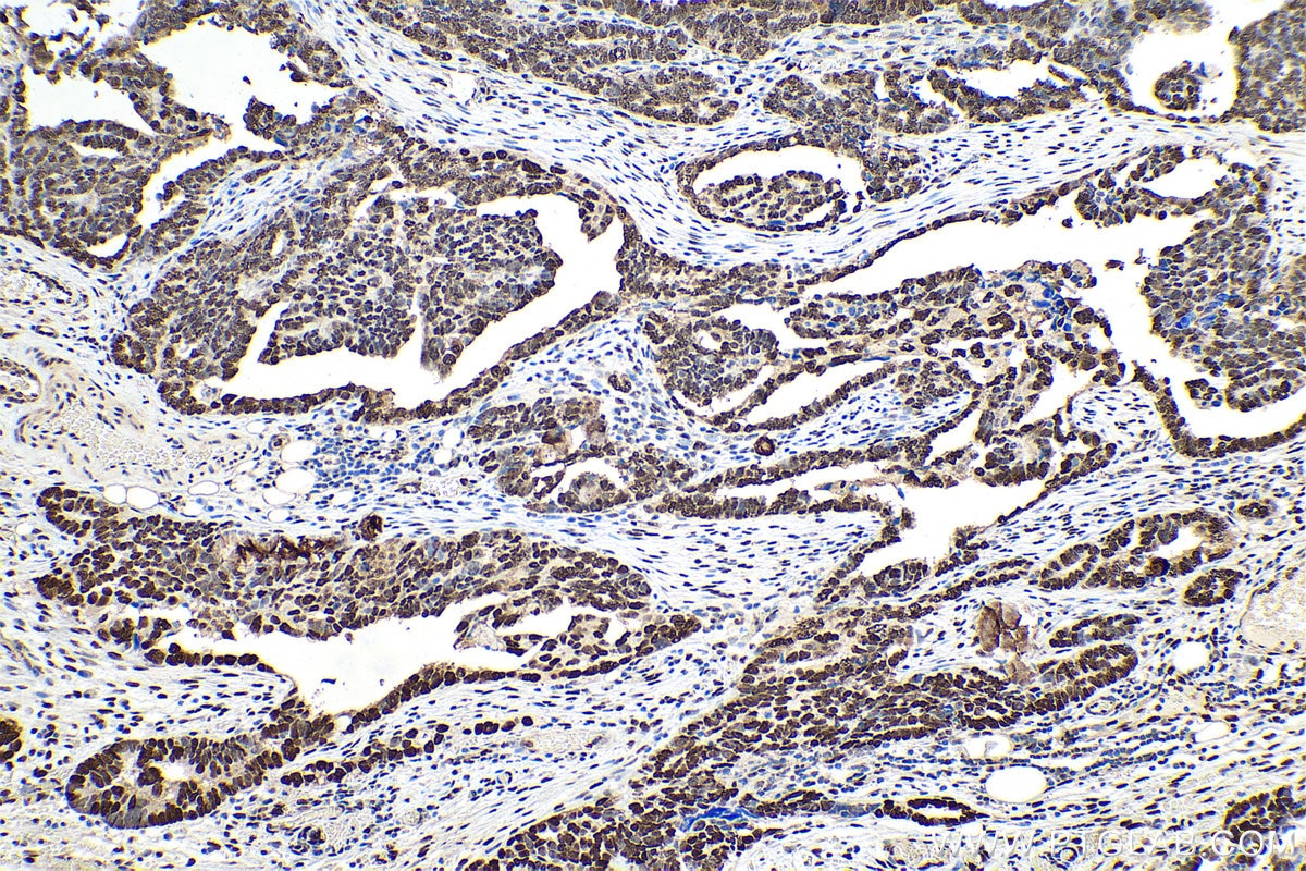 Immunohistochemical analysis of paraffin-embedded human ovary tumor tissue slide using KHC0898 (HDGF IHC Kit).