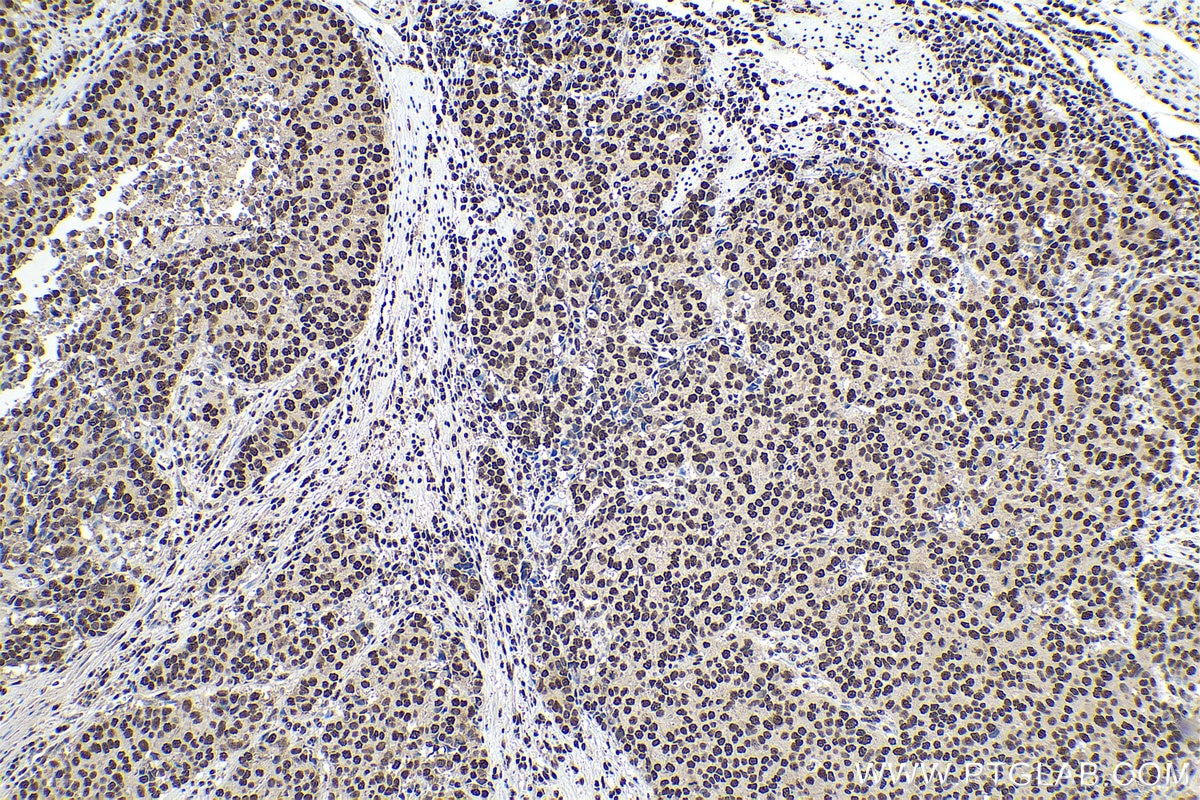 Immunohistochemical analysis of paraffin-embedded human stomach cancer tissue slide using KHC0898 (HDGF IHC Kit).
