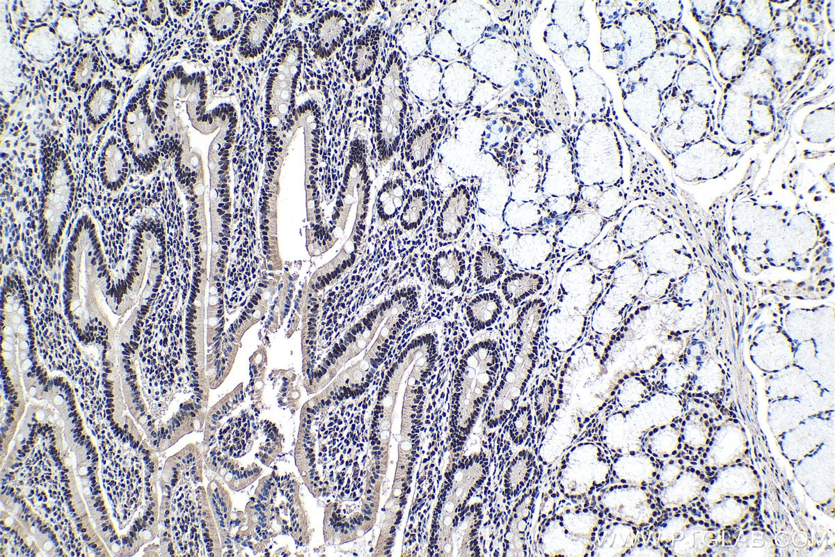 Immunohistochemical analysis of paraffin-embedded human stomach cancer tissue slide using KHC1402 (HDGFL2 IHC Kit).