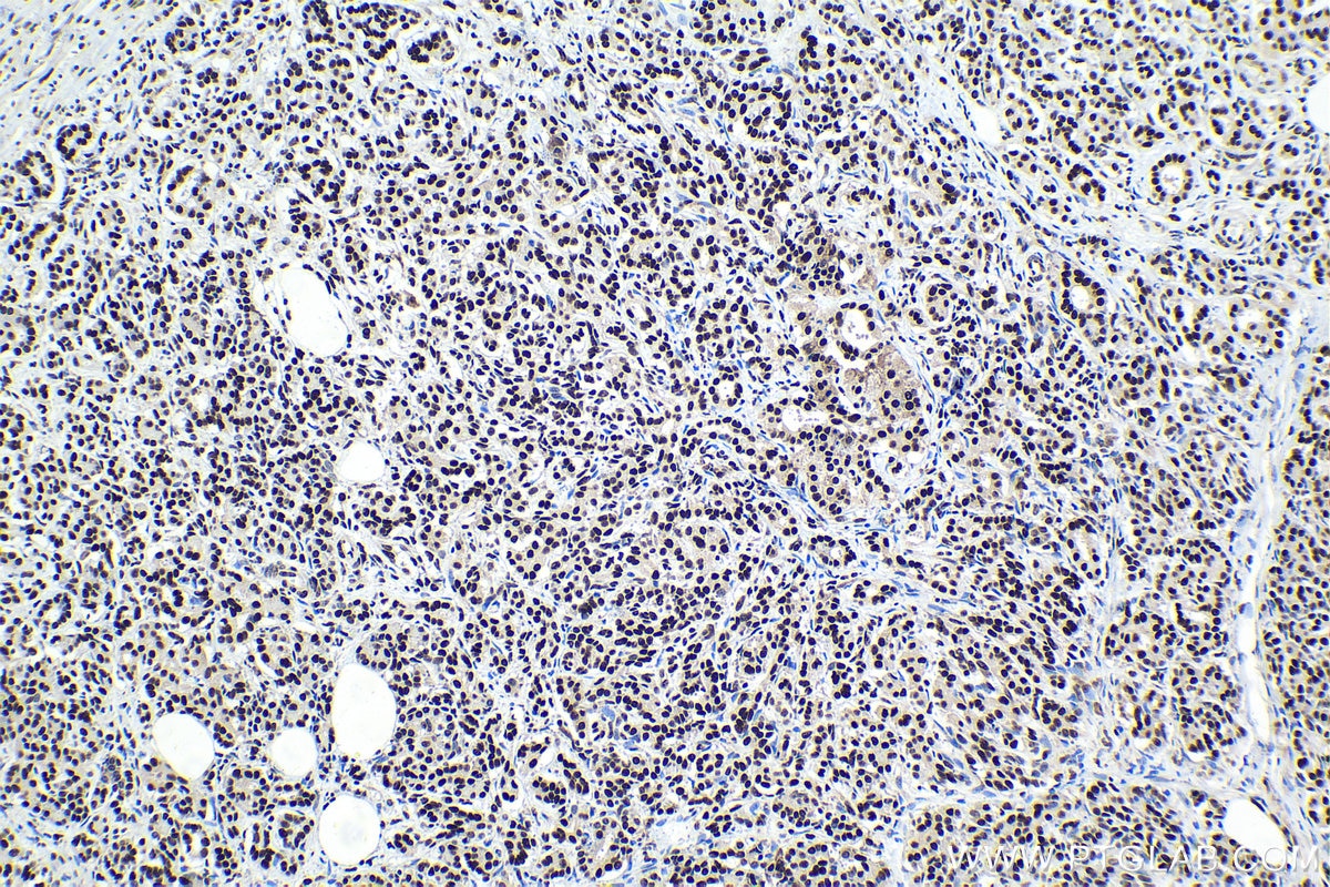 Immunohistochemical analysis of paraffin-embedded human pancreas cancer tissue slide using KHC1402 (HDGFL2 IHC Kit).