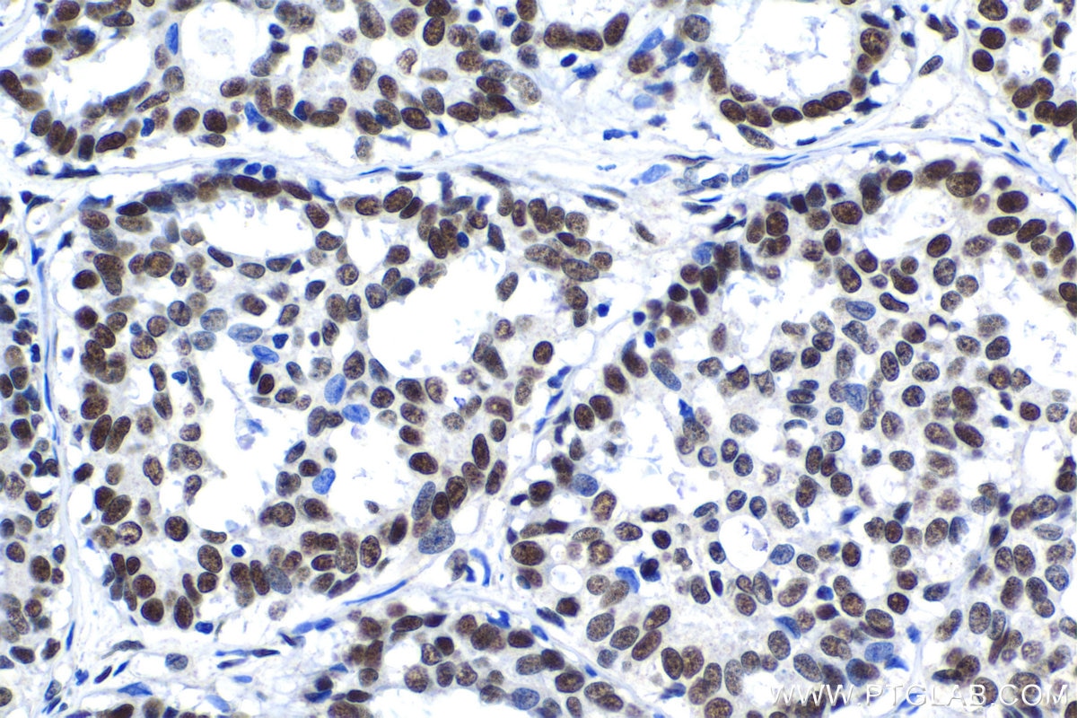 Immunohistochemical analysis of paraffin-embedded human breast cancer tissue slide using KHC1402 (HDGFL2 IHC Kit).