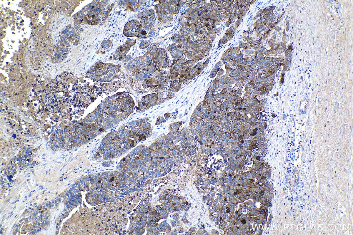 Immunohistochemical analysis of paraffin-embedded human ovary tumor tissue slide using KHC1165 (HE4 IHC Kit).