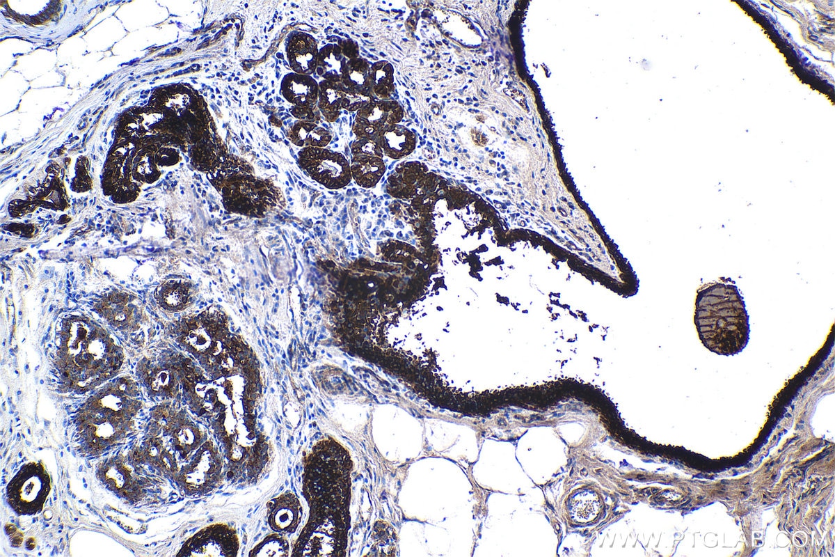 Immunohistochemical analysis of paraffin-embedded human breast cancer tissue slide using KHC1165 (HE4 IHC Kit).