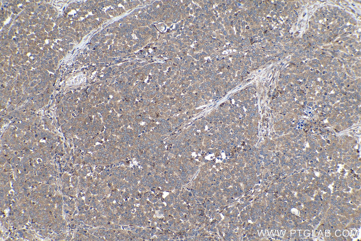 Immunohistochemical analysis of paraffin-embedded human ovary tumor tissue slide using KHC1133 (HEXB IHC Kit).