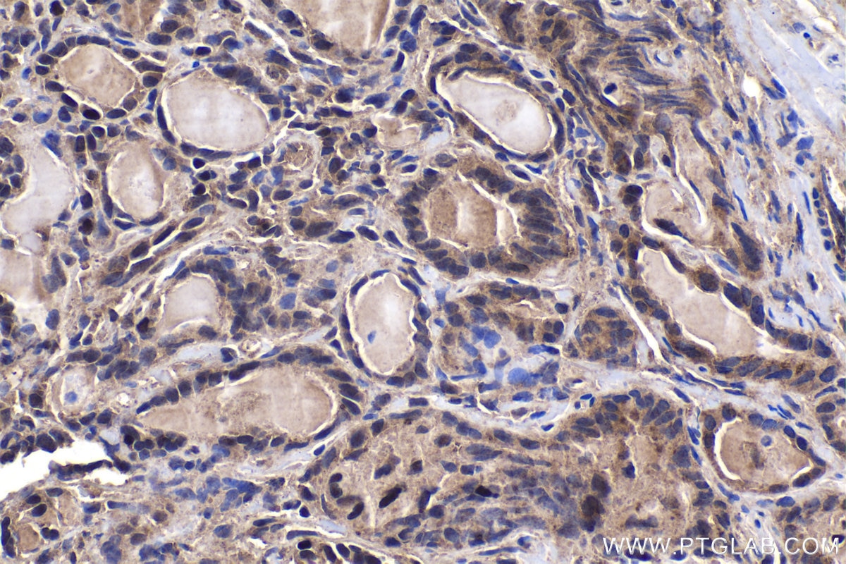 Immunohistochemical analysis of paraffin-embedded human thyroid cancer tissue slide using KHC1489 (HEXIM1 IHC Kit).