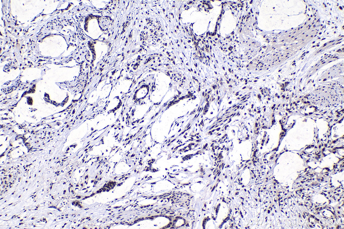 Immunohistochemical analysis of paraffin-embedded human urothelial carcinoma tissue slide using KHC1489 (HEXIM1 IHC Kit).