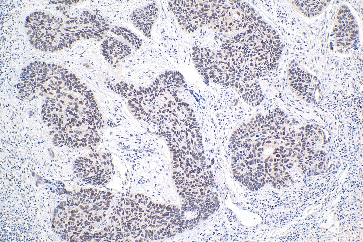 Immunohistochemical analysis of paraffin-embedded human lung cancer tissue slide using KHC1879 (HEXIM2 IHC Kit).