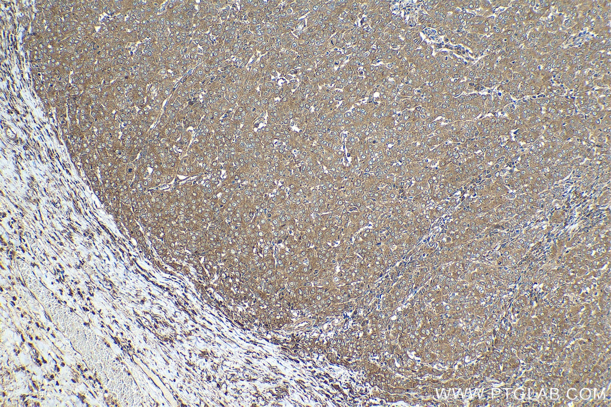 Immunohistochemical analysis of paraffin-embedded human ovary tumor tissue slide using KHC2063 (HGS IHC Kit).