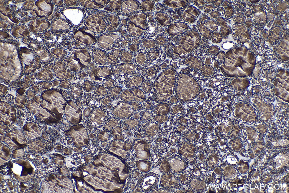 Immunohistochemical analysis of paraffin-embedded human thyroid cancer tissue slide using KHC1310 (HIBCH IHC Kit).