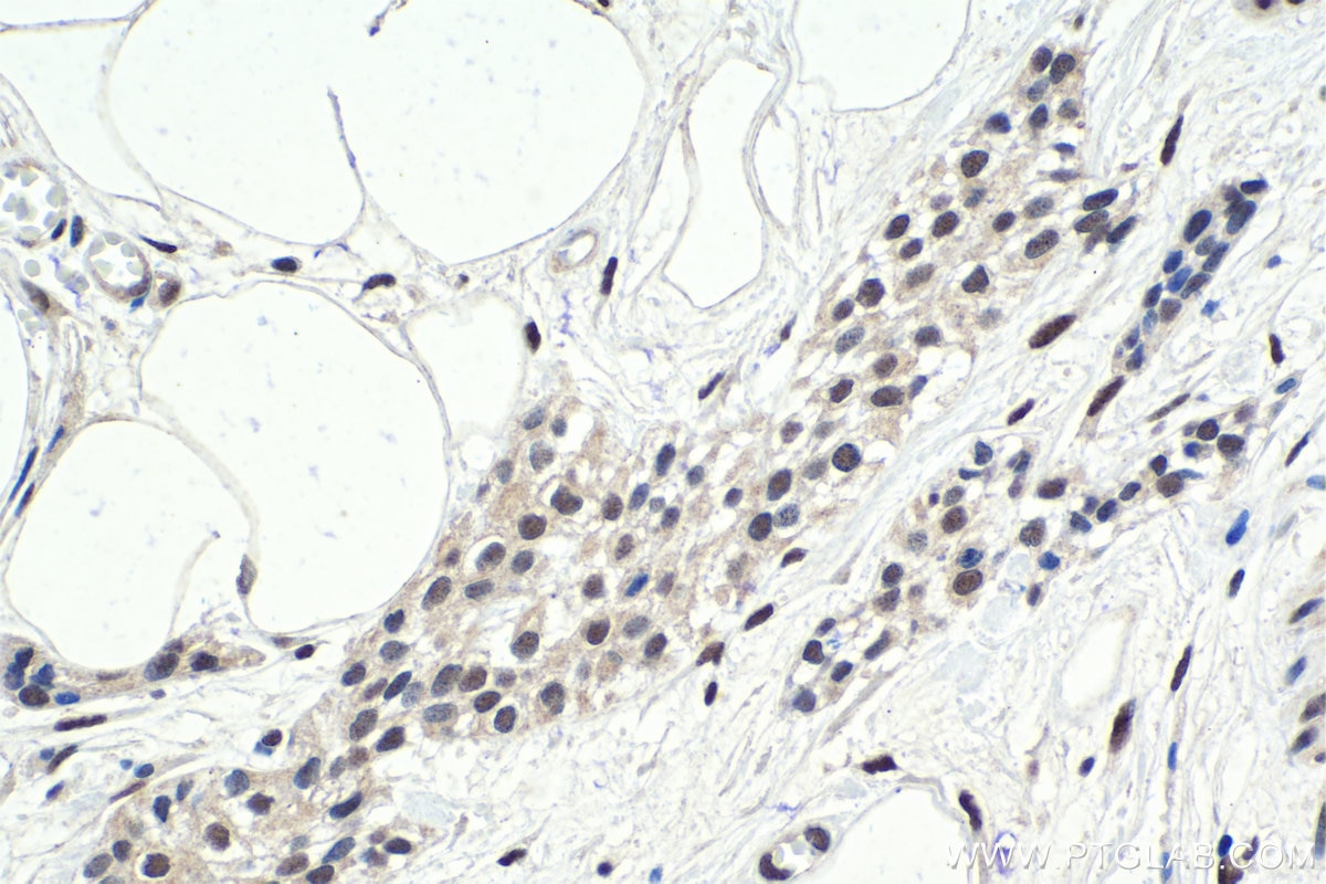 Immunohistochemical analysis of paraffin-embedded human urothelial carcinoma tissue slide using KHC1732 (HIC1 IHC Kit).