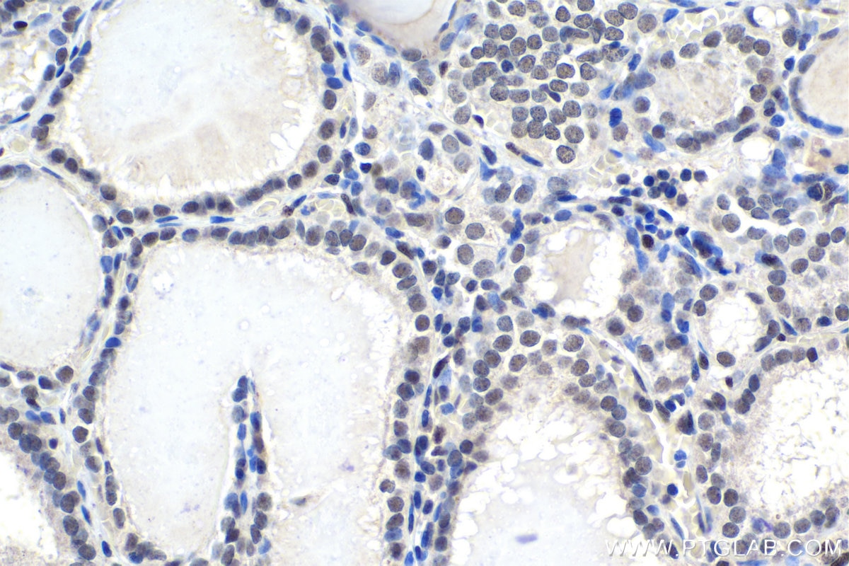 Immunohistochemical analysis of paraffin-embedded human thyroid cancer tissue slide using KHC1732 (HIC1 IHC Kit).