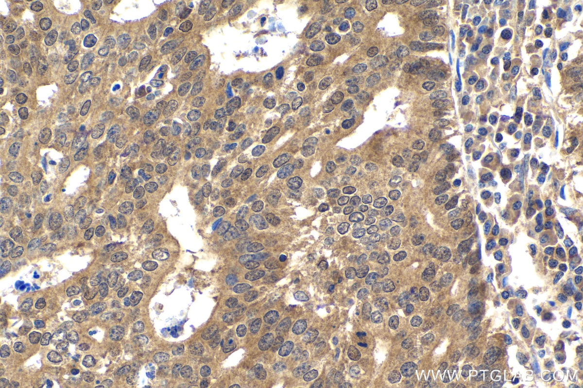 Immunohistochemical analysis of paraffin-embedded human endometrial cancer tissue slide using KHC1968 (HIF1AN IHC Kit).