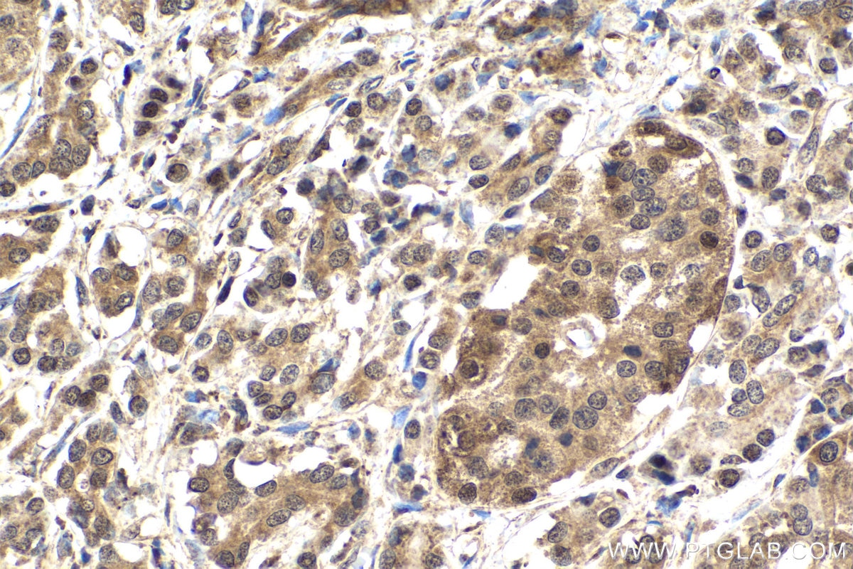 Immunohistochemical analysis of paraffin-embedded human pancreas cancer tissue slide using KHC2016 (HIF3A IHC Kit).