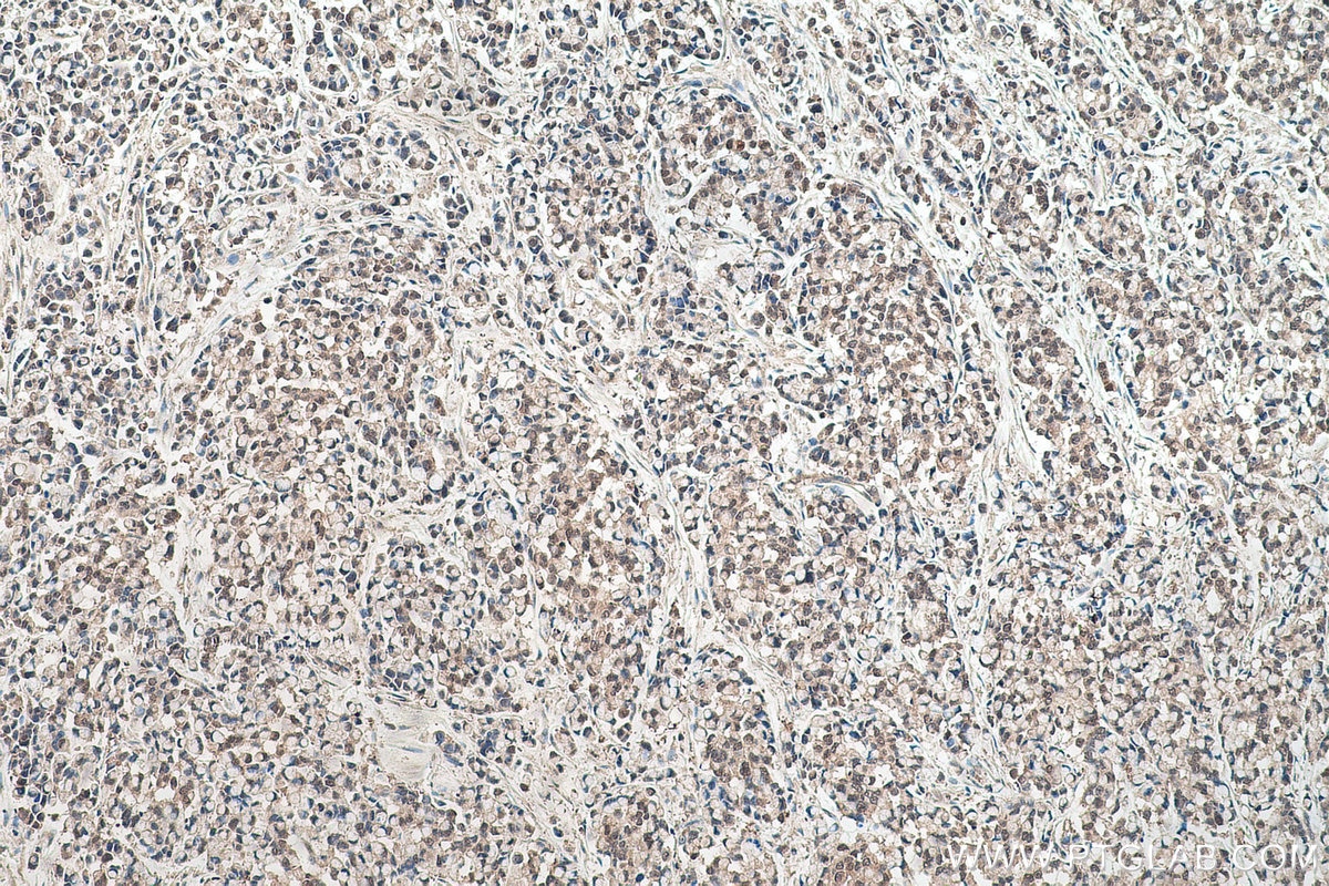 Immunohistochemical analysis of paraffin-embedded human colon cancer tissue slide using KHC0538 (HINT1 IHC Kit).