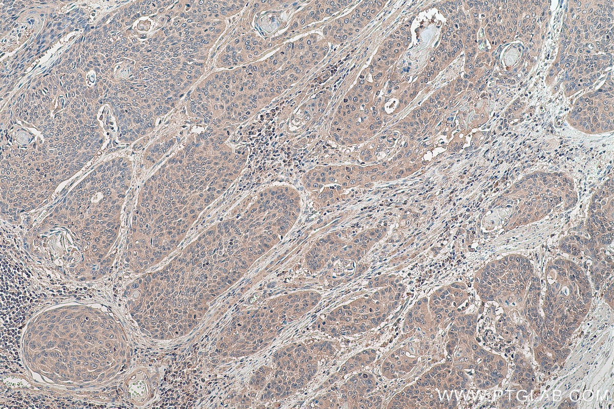Immunohistochemical analysis of paraffin-embedded human oesophagus cancer tissue slide using KHC0538 (HINT1 IHC Kit).