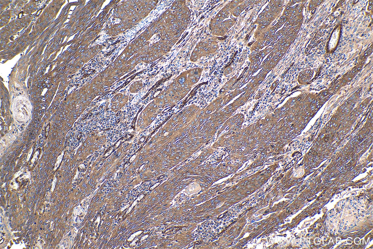 Immunohistochemical analysis of paraffin-embedded human oesophagus cancer tissue slide using KHC1420 (HIP1 IHC Kit).