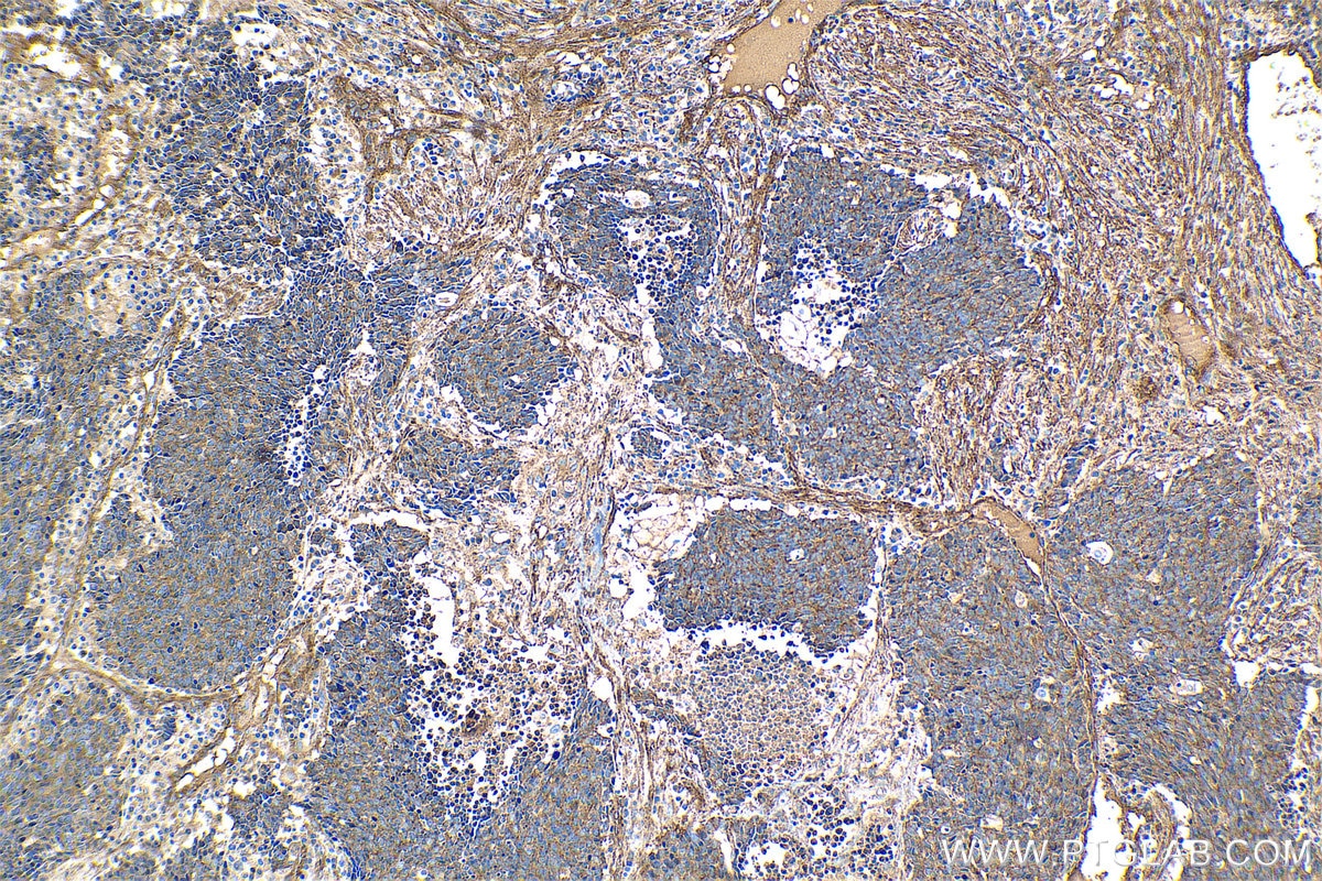 Immunohistochemical analysis of paraffin-embedded human lung cancer tissue slide using KHC1420 (HIP1 IHC Kit).