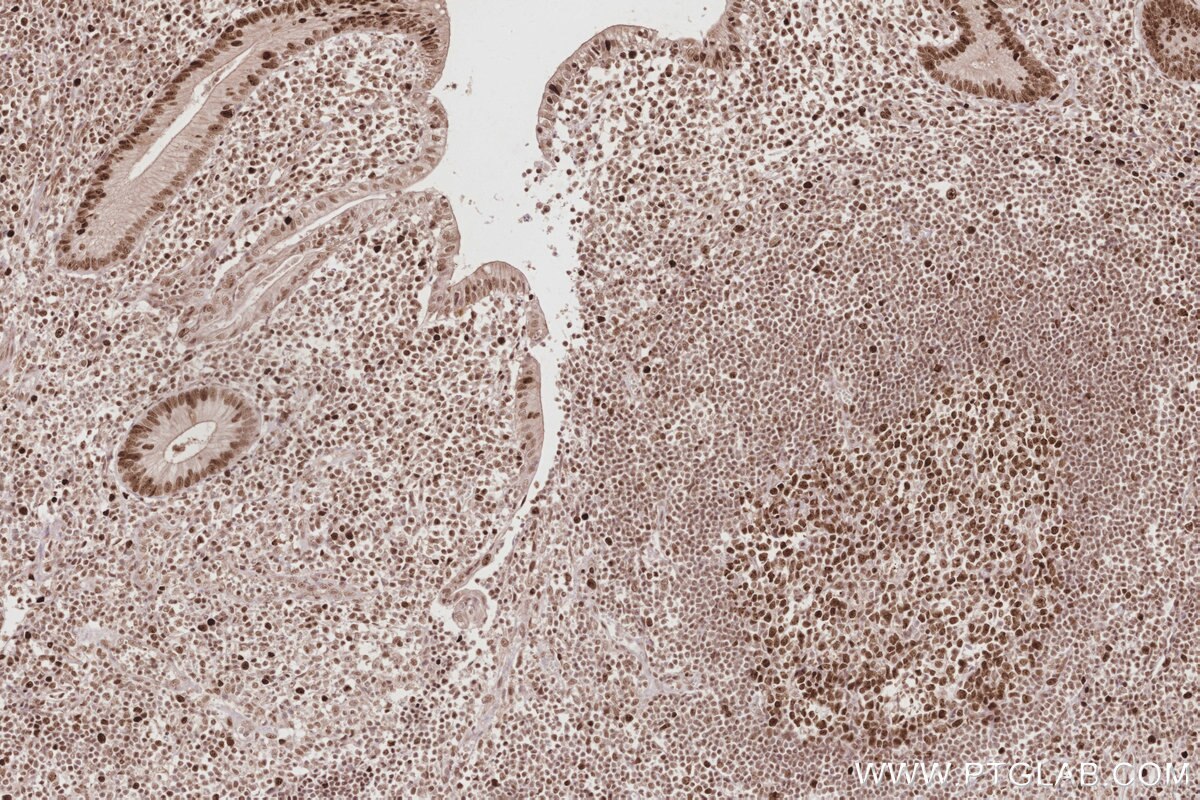Immunohistochemical analysis of paraffin-embedded human appendicitis tissue slide using KHC2877 (HIRIP3 IHC Kit). Immunohistochemical analysis of paraffin-embedded human appendicitis tissue slide using KHC2877 (HIRIP3 IHC Kit).