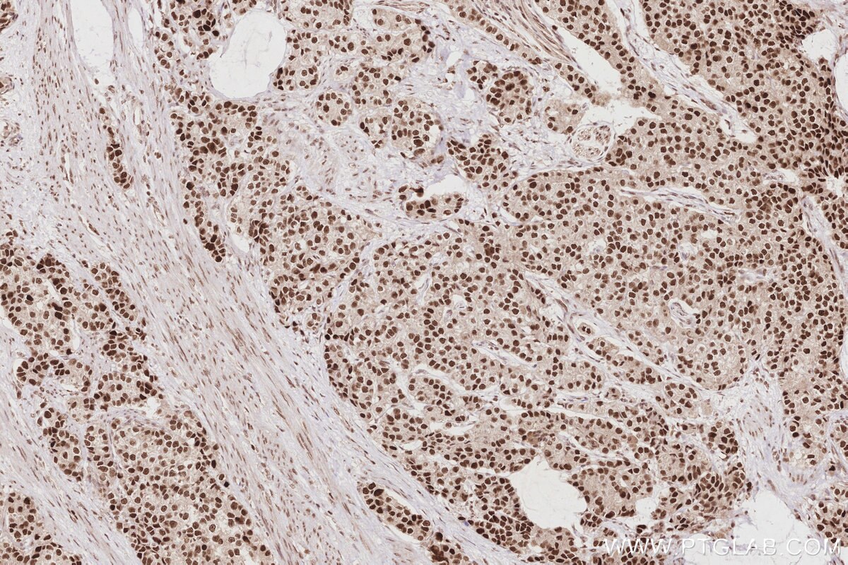 Immunohistochemical analysis of paraffin-embedded human stomach cancer tissue slide using KHC2877 (HIRIP3 IHC Kit). Immunohistochemical analysis of paraffin-embedded human stomach cancer tissue slide using KHC2877 (HIRIP3 IHC Kit).