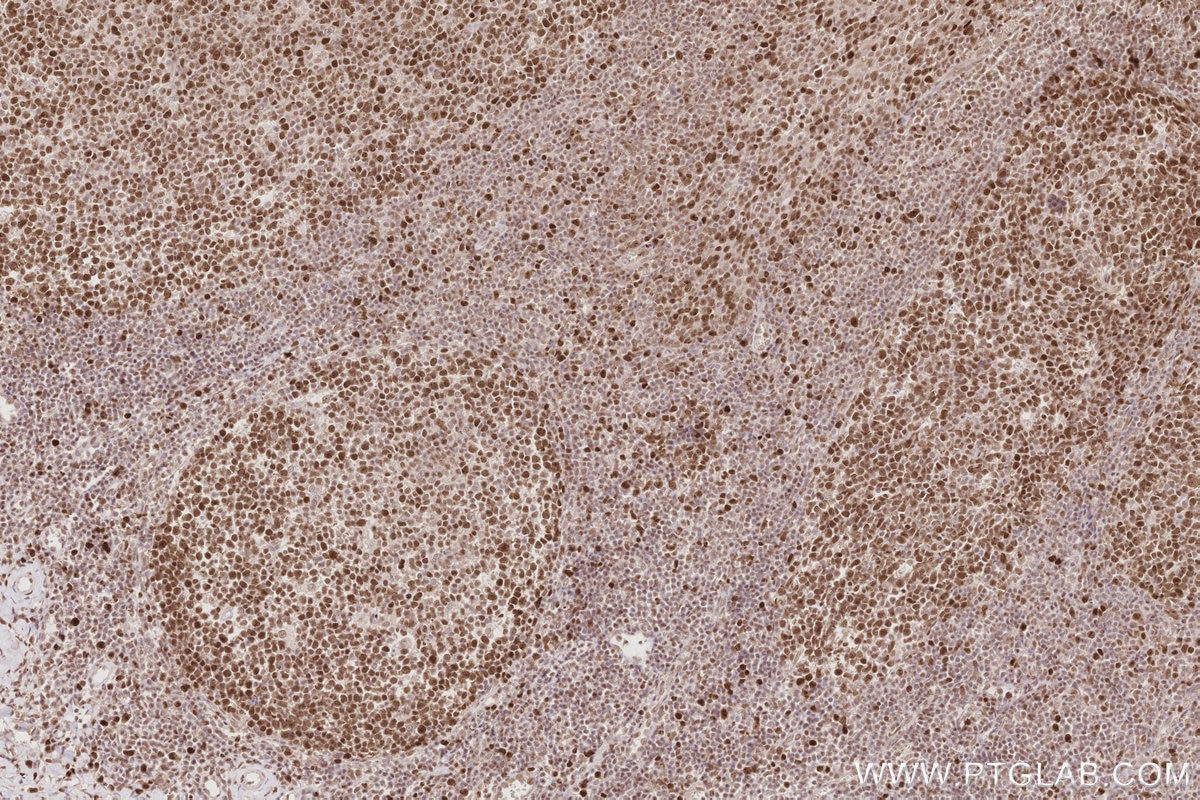 Immunohistochemical analysis of paraffin-embedded human tonsillitis tissue slide using KHC2877 (HIRIP3 IHC Kit). Immunohistochemical analysis of paraffin-embedded human tonsillitis tissue slide using KHC2877 (HIRIP3 IHC Kit).
