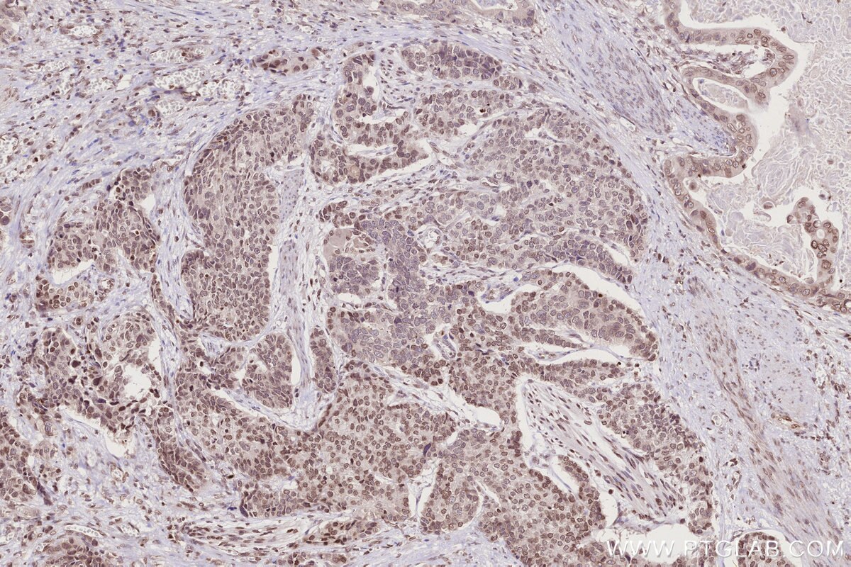 Immunohistochemical analysis of paraffin-embedded human stomach cancer tissue slide using KHC2771 (HIST1H2AC IHC Kit).