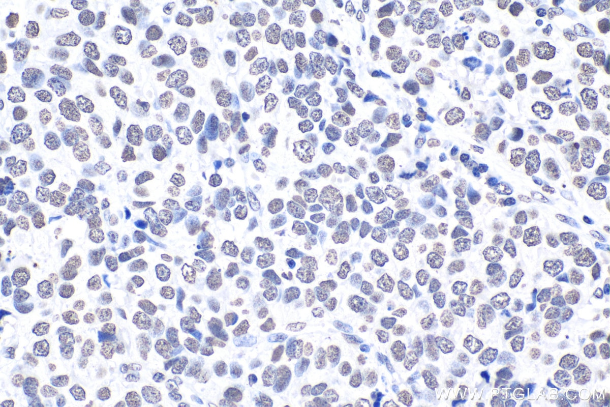 Immunohistochemical analysis of paraffin-embedded human stomach cancer tissue slide using KHC1675 (HIST1H3A IHC Kit).