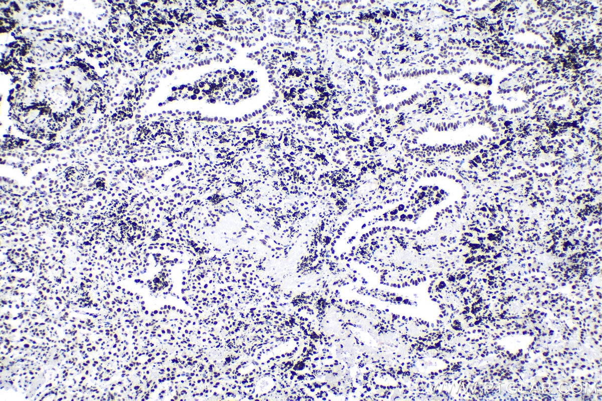 Immunohistochemical analysis of paraffin-embedded human lung cancer tissue slide using KHC1675 (HIST1H3A IHC Kit).