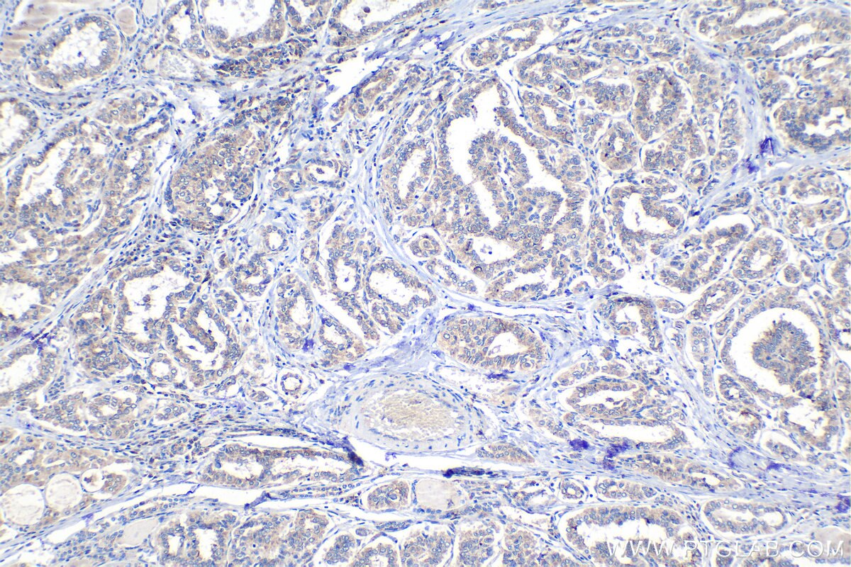 Immunohistochemical analysis of paraffin-embedded human thyroid cancer tissue slide using KHC1535 (HIVEP1 IHC Kit).