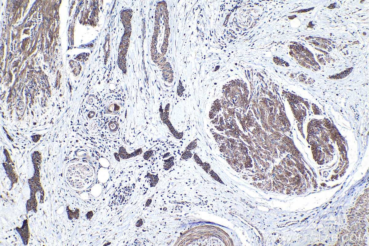 Immunohistochemical analysis of paraffin-embedded human urothelial carcinoma tissue slide using KHC1109 (HK2 IHC Kit).