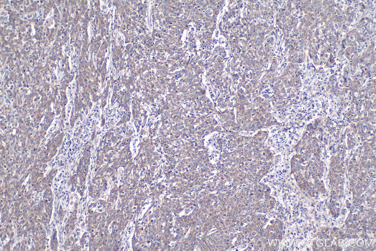 Immunohistochemical analysis of paraffin-embedded human cervical cancer tissue slide using KHC1109 (HK2 IHC Kit).