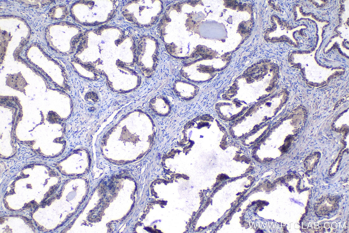 Immunohistochemical analysis of paraffin-embedded human prostate cancer tissue slide using KHC1109 (HK2 IHC Kit).