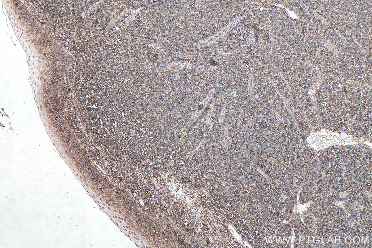 Immunohistochemical analysis of paraffin-embedded human tonsillitis tissue slide using KHC0093 (HLA class I ABC IHC Kit).