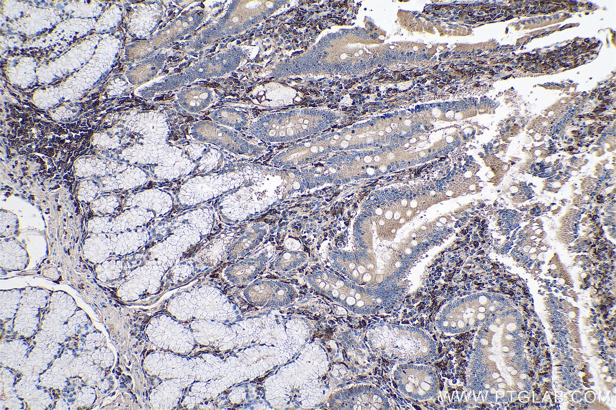 Immunohistochemical analysis of paraffin-embedded human stomach cancer tissue slide using KHC0623 (HLA-DRB1 IHC Kit).